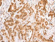 TAX1BP1 Antibody - Immunohistochemistry of paraffin-embedded Human esophagus cancer using TAX1BP1 Polyclonal Antibody at dilution of 1:60.