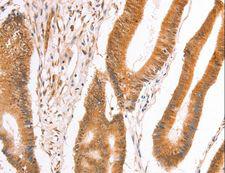 TAX1BP1 Antibody - Immunohistochemistry of paraffin-embedded Human thyroid cancer using TAX1BP1 Polyclonal Antibody at dilution of 1:40.
