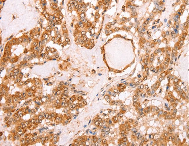 TAX1BP1 Antibody - Immunohistochemistry of paraffin-embedded Human thyroid cancer using TAX1BP1 Polyclonal Antibody at dilution of 1:40.