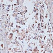 TAX1BP1 Antibody - Immunohistochemistry of paraffin-embedded Human lung cancer using TAX1BP1 Polyclonal Antibody at dilution of 1:100 (40x lens).