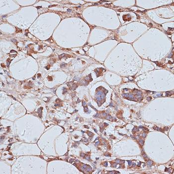 TAX1BP1 Antibody - Immunohistochemistry of paraffin-embedded Human breast cancer using TAX1BP1 Polyclonal Antibody at dilution of 1:100 (40x lens).