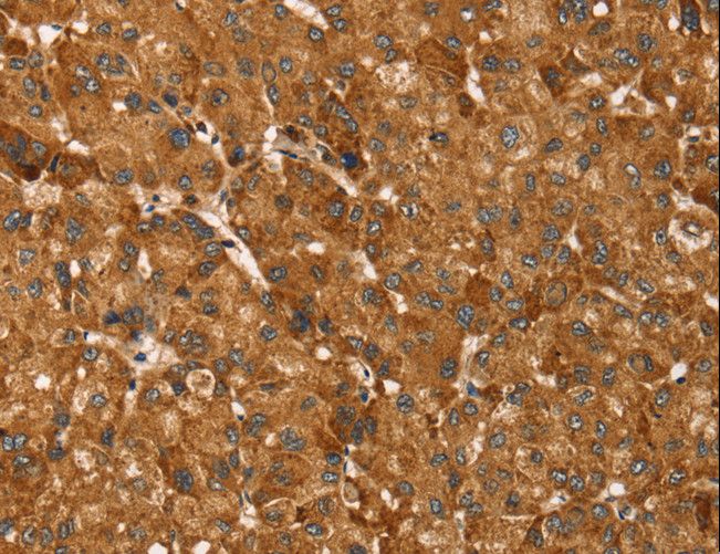 TBC1 / TBC1D1 Antibody - Immunohistochemistry of paraffin-embedded Human breast cancer using TBC1D1 Polyclonal Antibody at dilution of 1:45.
