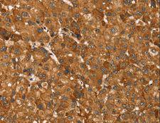 TBC1 / TBC1D1 Antibody - Immunohistochemistry of paraffin-embedded Human breast cancer using TBC1D1 Polyclonal Antibody at dilution of 1:45.