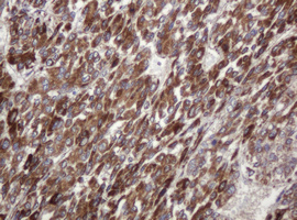 TBC1D13 Antibody - IHC of paraffin-embedded Carcinoma of Human liver tissue using anti-TBC1D13 mouse monoclonal antibody.