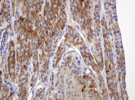 TBC1D13 Antibody - IHC of paraffin-embedded Carcinoma of Human thyroid tissue using anti-TBC1D13 mouse monoclonal antibody.