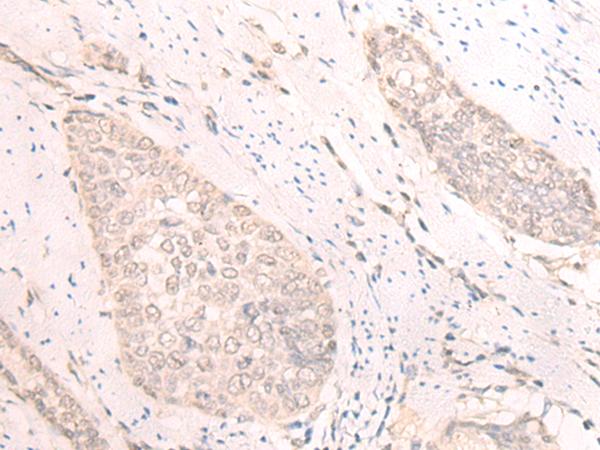 TBC1D2 Antibody - Immunohistochemistry of paraffin-embedded Human esophagus cancer tissue  using TBC1D2 Polyclonal Antibody at dilution of 1:25(×200)