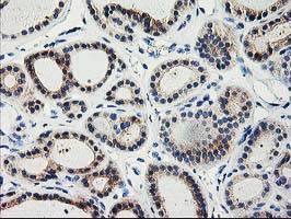 TBC1D21 Antibody - IHC of paraffin-embedded Carcinoma of Human thyroid tissue using anti-TBC1D21 mouse monoclonal antibody.