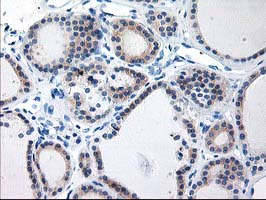 TBC1D21 Antibody - IHC of paraffin-embedded Carcinoma of Human thyroid tissue using anti-TBC1D21 mouse monoclonal antibody.