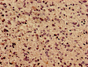 TBC1D31 / WDR67 Antibody - Immunocytochemistry analysis of human glioma cancer diluted at 1:100