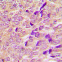 TBC1D4 / AS160 Antibody - Immunohistochemical analysis of AS160 staining in human breast cancer formalin fixed paraffin embedded tissue section. The section was pre-treated using heat mediated antigen retrieval with sodium citrate buffer (pH 6.0). The section was then incubated with the antibody at room temperature and detected using an HRP conjugated compact polymer system. DAB was used as the chromogen. The section was then counterstained with hematoxylin and mounted with DPX.