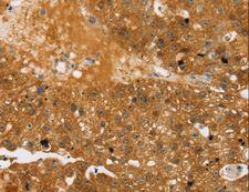 TBC1D4 / AS160 Antibody - Immunohistochemistry of paraffin-embedded Human breast cancer using TBC1D4 Polyclonal Antibody at dilution of 1:40.