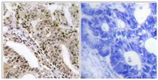 TBC1D4 / AS160 Antibody - Immunohistochemistry analysis of paraffin-embedded human lung carcinoma, using AS160 (Phospho-Thr642) Antibody. The picture on the right is blocked with the phospho peptide.