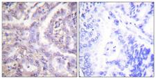 TBC1D4 / AS160 Antibody - P-peptide - + Immunohistochemistry analysis of paraffin-embedded human lung carcinoma tissue using AS160 (Phospho-Thr642) antibody.