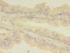 TBCA Antibody - Immunohistochemistry of paraffin-embedded human prostate cancer using antibody at dilution of 1:100.