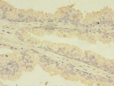 TBCA Antibody - Immunohistochemistry of paraffin-embedded human prostate cancer using TBCA Antibody at dilution of 1:100