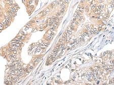 TBCB / CKAP1 Antibody - Immunohistochemistry of paraffin-embedded Human gastric cancer tissue  using TBCB Polyclonal Antibody at dilution of 1:25(×200)