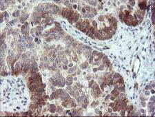 TBCC Antibody - IHC of paraffin-embedded Adenocarcinoma of Human ovary tissue using anti-TBCC mouse monoclonal antibody. (Heat-induced epitope retrieval by 10mM citric buffer, pH6.0, 100C for 10min).