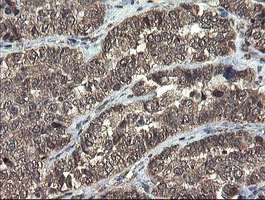 TBCC Antibody - IHC of paraffin-embedded Adenocarcinoma of Human ovary tissue using anti-TBCC mouse monoclonal antibody.