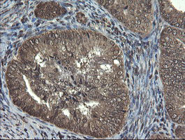 TBCC Antibody - IHC of paraffin-embedded Adenocarcinoma of Human endometrium tissue using anti-TBCC mouse monoclonal antibody.