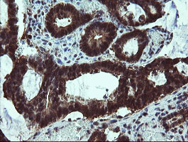 TBCC Antibody - IHC of paraffin-embedded Adenocarcinoma of Human colon tissue using anti-TBCC mouse monoclonal antibody.