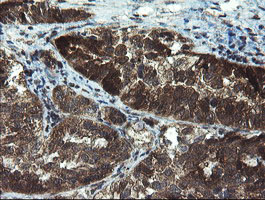 TBCC Antibody - IHC of paraffin-embedded Adenocarcinoma of Human ovary tissue using anti-TBCC mouse monoclonal antibody.
