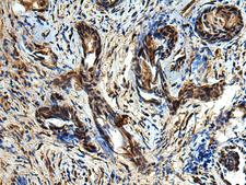 TBCC Antibody - Immunohistochemistry of paraffin-embedded Human prost at e cancer tissue  using TBCC Polyclonal Antibody at dilution of 1:80(×200)