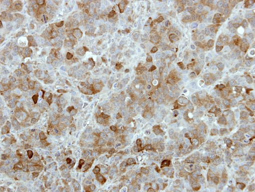 TBCK / TBCKL Antibody - IHC of paraffin-embedded MCF7 xenograft using TBCK antibody at 1:100 dilution.