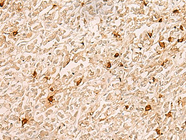 TBCK / TBCKL Antibody - Immunohistochemistry of paraffin-embedded Human gastric cancer tissue  using TBCK Polyclonal Antibody at dilution of 1:25(×200)