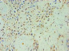 TBL1XR1 / TBLR1 Antibody - Immunohistochemistry of paraffin-embedded human breast cancer using antibody at 1:100 dilution.
