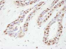 TBL1XR1 / TBLR1 Antibody - Detection of Human TBLR1 by Immunohistochemistry. Sample: FFPE section of human prostate adenocarcinoma. Antibody: Affinity purified rabbit anti-TBLR1 used at a dilution of 1:250. Detection: DAB.