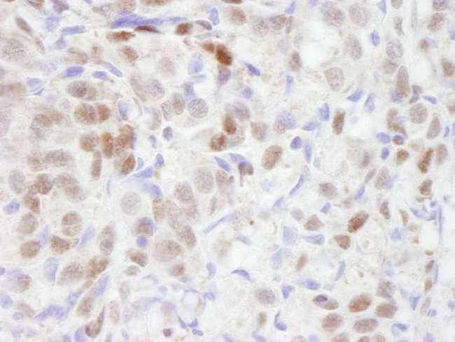 TBL1XR1 / TBLR1 Antibody - Detection of Human TBLR1 by Immunohistochemistry. Sample: FFPE section of human breast adenocarcinoma. Antibody: Affinity purified rabbit anti-TBLR1 used at a dilution of 1:250. Detection: DAB.