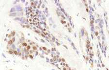 TBL1XR1 / TBLR1 Antibody - Detection of Human TBLR1 by Immunohistochemistry. Sample: FFPE section of human prostate carcinoma. Antibody: Affinity purified rabbit anti-TBLR1 used at a dilution of 1:1000 (1 ug/ml). Detection: DAB.