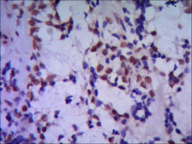 TBL1XR1 / TBLR1 Antibody - IHC of paraffin-embedded human breast cancer using anti- TBLR1 diluted 1/500-1/1000.