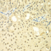 TBL1XR1 / TBLR1 Antibody - Immunohistochemistry of paraffin-embedded human oophoroma tissue.