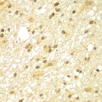 TBL1XR1 / TBLR1 Antibody - Immunohistochemistry of paraffin-embedded human brain cancer tissue.