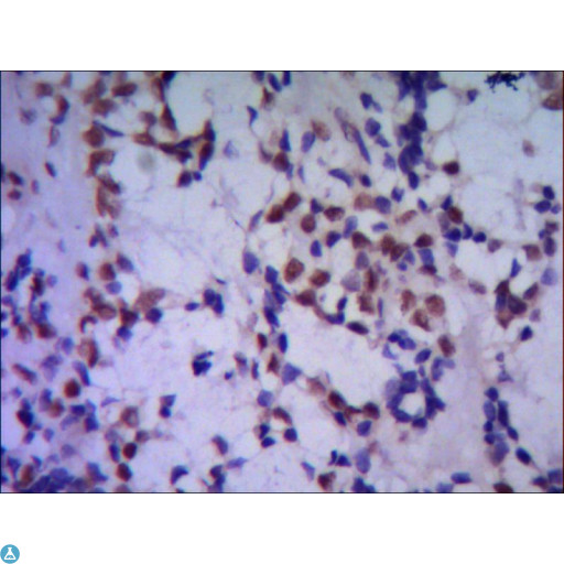 TBL1XR1 / TBLR1 Antibody - IHC of paraffin-embedded huma breast cancer using anti-TBLR1 mouse mAb diluted 1:500-1:1000.
