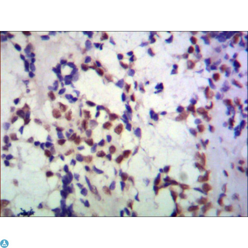TBL1XR1 / TBLR1 Antibody - Immunohistochemistry (IHC) analysis of paraffin-embedded huma breast cancer using TBL1XR1 Monoclonal Antibody.