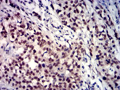 TBP / GTF2D Antibody - Immunohistochemical analysis of paraffin-embedded bladder cancer tissues using TBP mouse mAb with DAB staining.