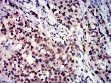 TBP / GTF2D Antibody - Immunohistochemical analysis of paraffin-embedded bladder cancer tissues using TBP mouse mAb with DAB staining.