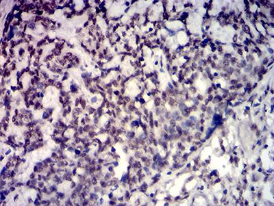 TBP / GTF2D Antibody - Immunohistochemical analysis of paraffin-embedded esophageal cancer tissues using TBP mouse mAb with DAB staining.