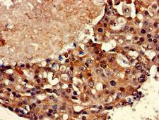 TBP / GTF2D Antibody - Immunohistochemistry of paraffin-embedded human breast cancer using TBP Antibody at dilution of 1:100