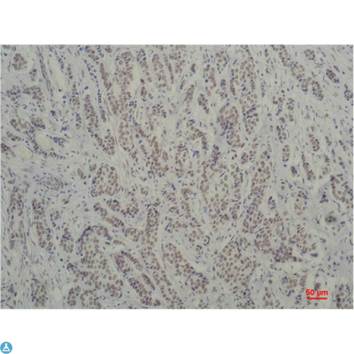 TBP / GTF2D Antibody - Immunohistochemistry (IHC) analysis of paraffin-embedded Human Breast Carcinoma using TBP/TATA Binding Protein Mouse Monoclonal Antibody diluted at 1:200.