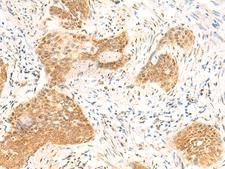 TBPL1 / TRF2 Antibody - Immunohistochemistry of paraffin-embedded Human esophagus cancer tissue  using TBPL1 Polyclonal Antibody at dilution of 1:50(×200)