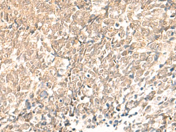 TBPL1 / TRF2 Antibody - Immunohistochemistry of paraffin-embedded Human lung cancer tissue  using TBPL1 Polyclonal Antibody at dilution of 1:50(×200)