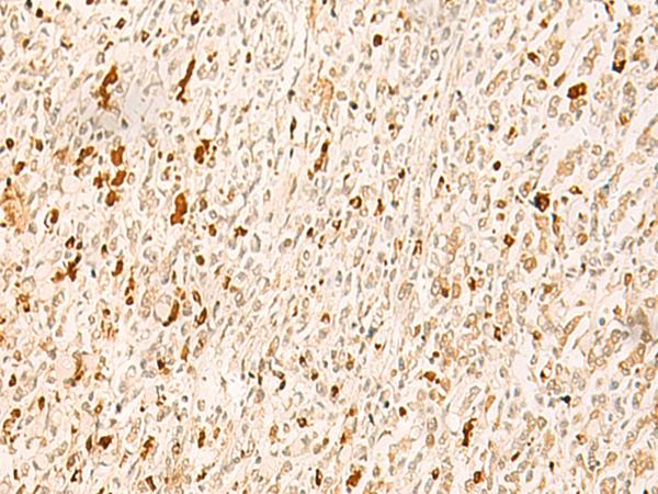 TBPL1 / TRF2 Antibody - Immunohistochemistry of paraffin-embedded Human gastric cancer tissue  using TBPL1 Polyclonal Antibody at dilution of 1:50(×200)