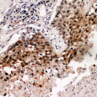 TBPL2 / TRF3 Antibody - Immunohistochemical analysis of TRF3 staining in human lung cancer formalin fixed paraffin embedded tissue section. The section was pre-treated using heat mediated antigen retrieval with sodium citrate buffer (pH 6.0). The section was then incubated with the antibody at room temperature and detected using an HRP conjugated compact polymer system. DAB was used as the chromogen. The section was then counterstained with haematoxylin and mounted with DPX.