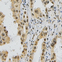 TBX1 Antibody - Immunohistochemical analysis of TBX1 staining in human lung cancer formalin fixed paraffin embedded tissue section. The section was pre-treated using heat mediated antigen retrieval with sodium citrate buffer (pH 6.0). The section was then incubated with the antibody at room temperature and detected with HRP and DAB as chromogen. The section was then counterstained with hematoxylin and mounted with DPX.