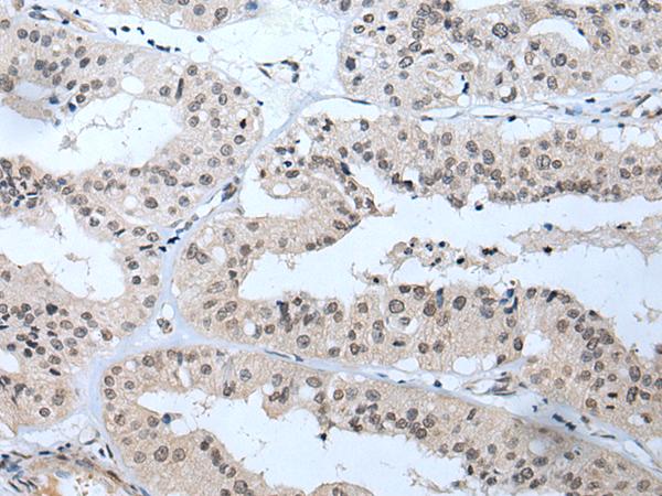 TBX1 Antibody - Immunohistochemistry of paraffin-embedded Human liver cancer tissue  using TBX1 Polyclonal Antibody at dilution of 1:40(×200)