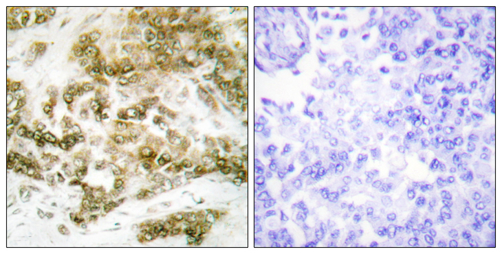 TBX15+18 Antibody - Immunohistochemistry analysis of paraffin-embedded human breast carcinoma tissue, using TBX15/18 Antibody. The picture on the right is blocked with the synthesized peptide.
