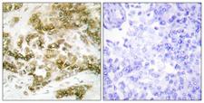 TBX15+18 Antibody - Peptide - + Immunohistochemistry analysis of paraffin-embedded human breast carcinoma tissue using TBX15/18 antibody.